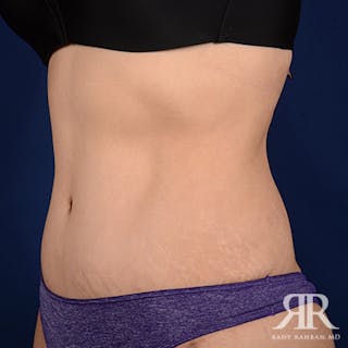 Tummy Tuck Before & After Gallery - Patient 162116 - Image 4