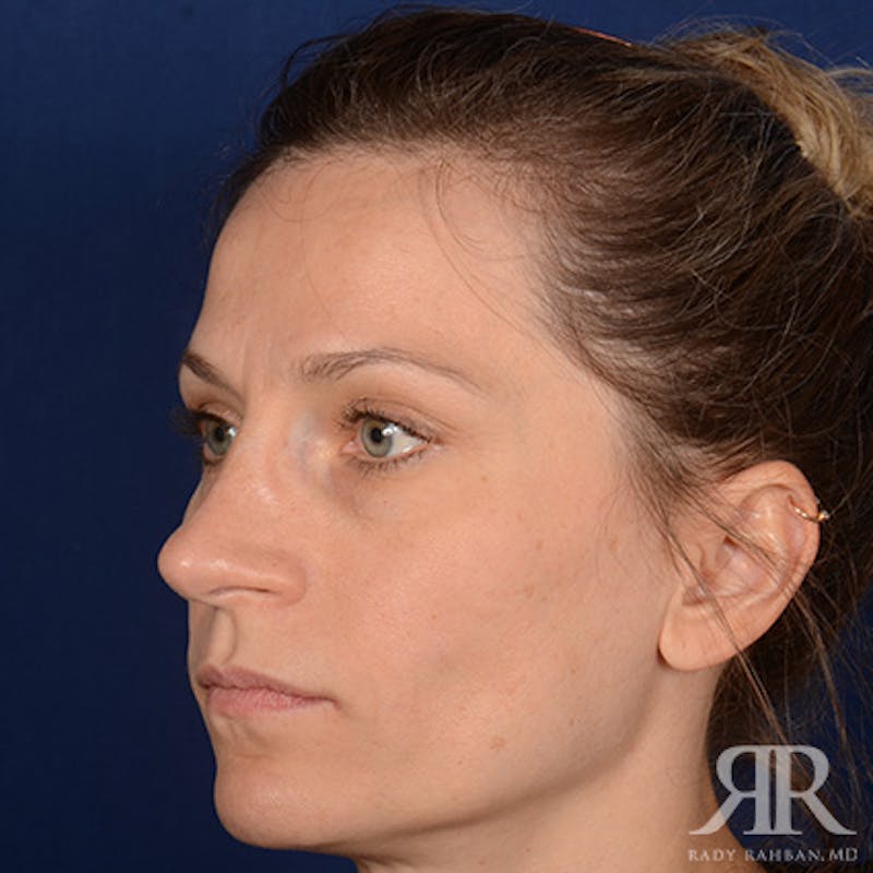 Female Rhinoplasty Before & After Gallery - Patient 994367 - Image 4