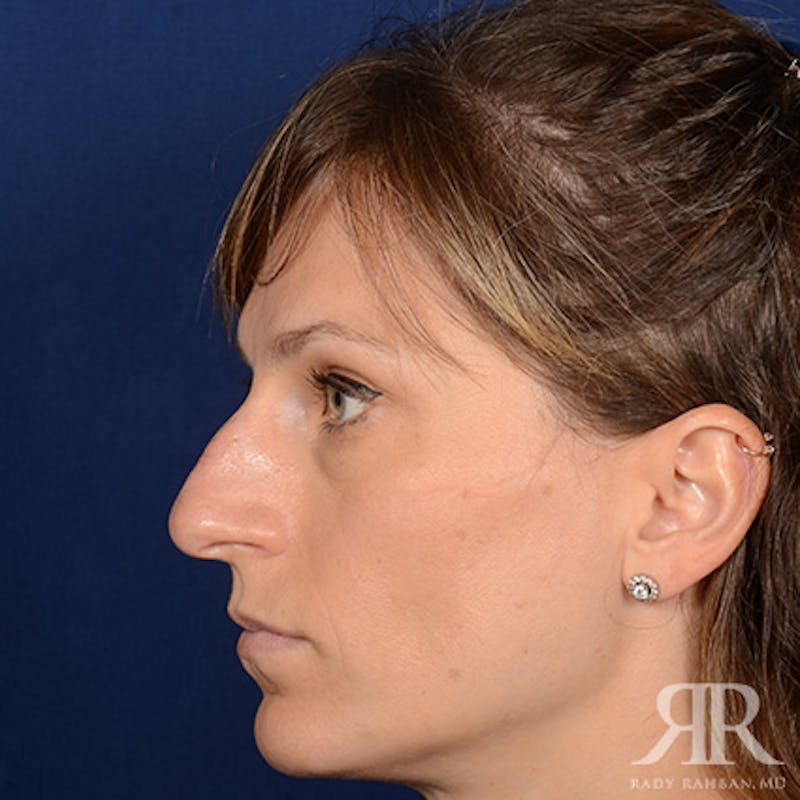 Female Rhinoplasty Before & After Gallery - Patient 994367 - Image 5
