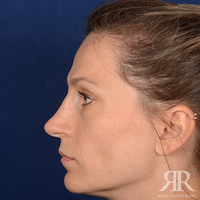 Female Rhinoplasty Before & After Gallery - Patient 994367 - Image 6