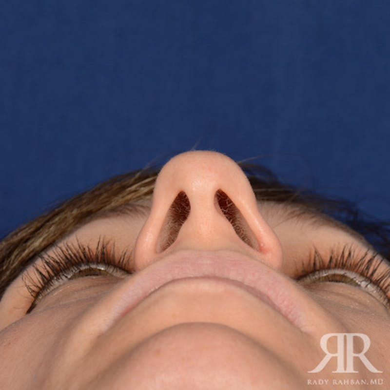 Female Rhinoplasty Before & After Gallery - Patient 994367 - Image 7