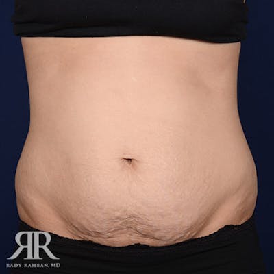 Tummy Tuck Before & After Gallery - Patient 193790 - Image 1