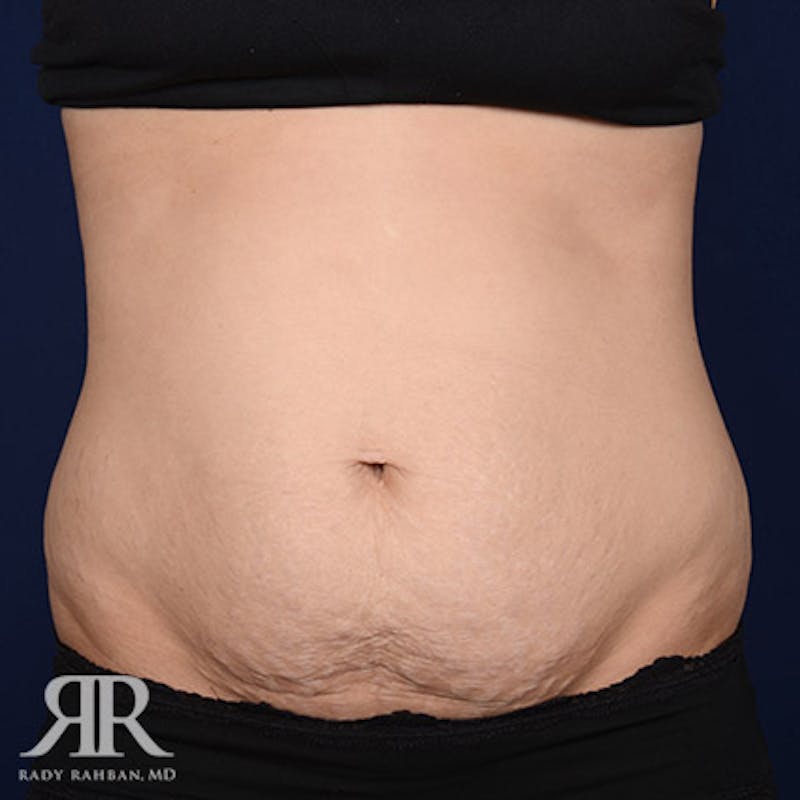 Tummy Tuck Before & After Gallery - Patient 193790 - Image 1