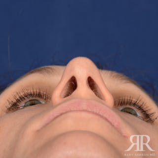 Female Rhinoplasty Before & After Gallery - Patient 994367 - Image 8