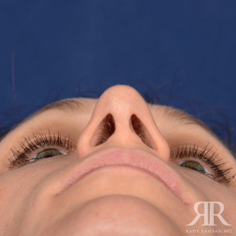 Female Rhinoplasty Before & After Gallery - Patient 994367 - Image 8