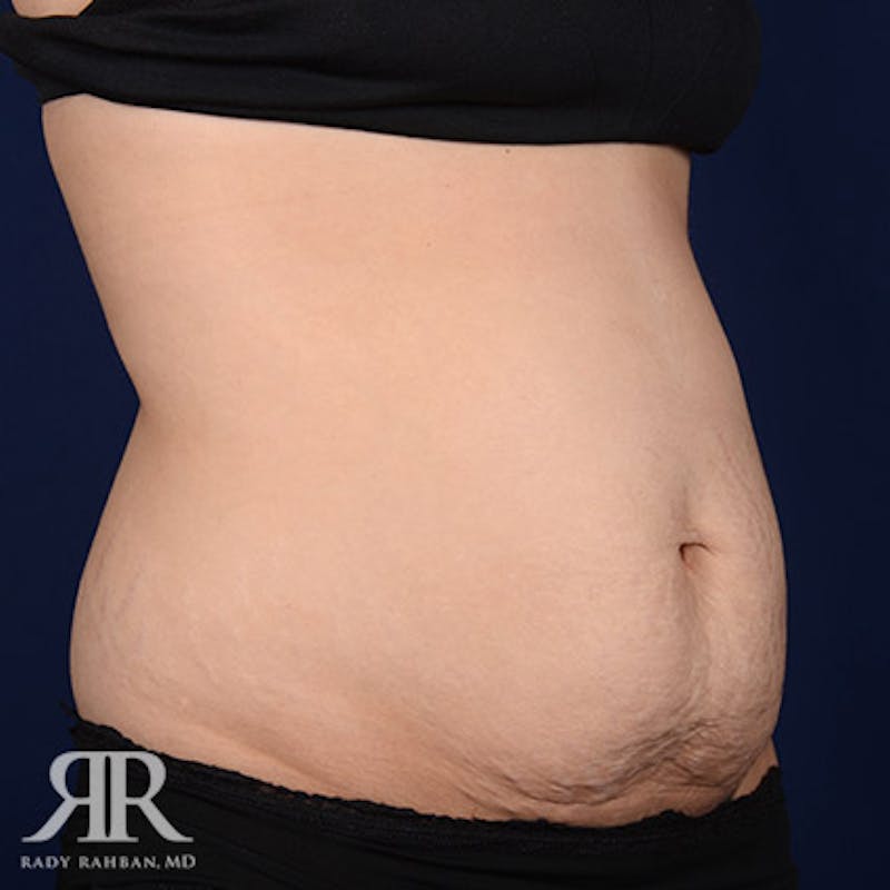 Tummy Tuck Before & After Gallery - Patient 193790 - Image 3