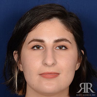 Female Rhinoplasty Before & After Gallery - Patient 291536 - Image 1