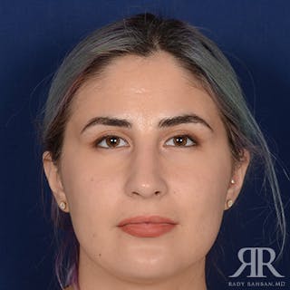 Female Rhinoplasty Before & After Gallery - Patient 291536 - Image 2