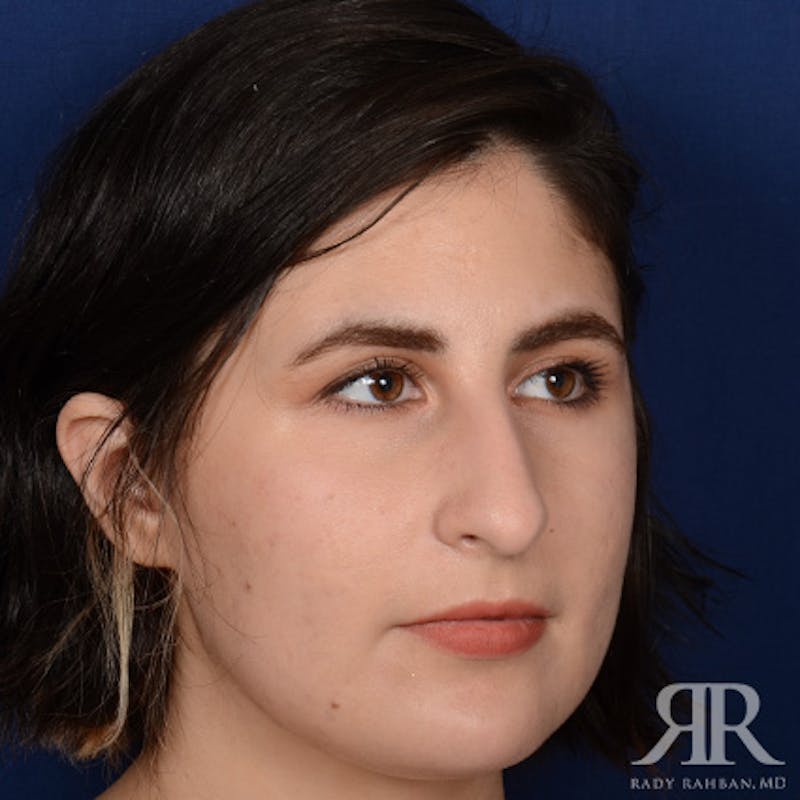 Female Rhinoplasty Before & After Gallery - Patient 291536 - Image 3