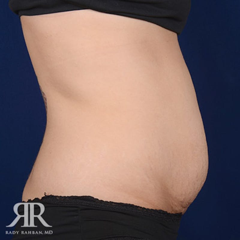 Tummy Tuck Before & After Gallery - Patient 193790 - Image 5