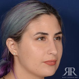 Female Rhinoplasty Before & After Gallery - Patient 291536 - Image 4