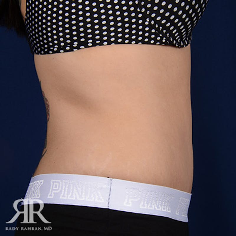 Tummy Tuck Before & After Gallery - Patient 193790 - Image 6
