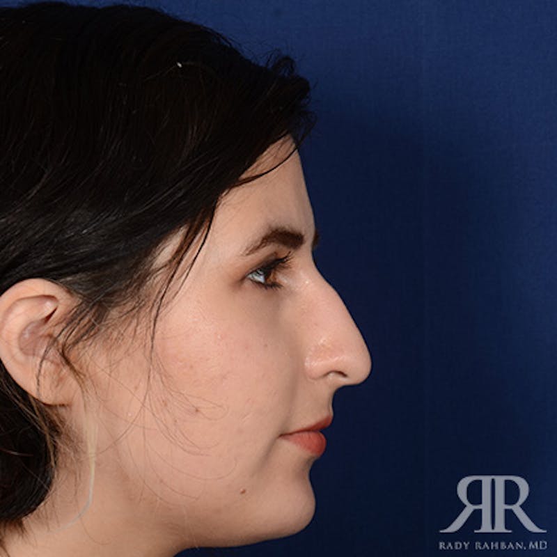 Female Rhinoplasty Before & After Gallery - Patient 291536 - Image 5