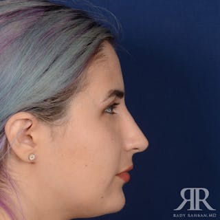 Female Rhinoplasty Before & After Gallery - Patient 291536 - Image 6