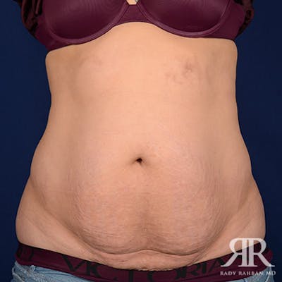 Tummy Tuck Before & After Gallery - Patient 275664 - Image 1