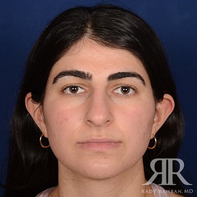 Female Rhinoplasty Before & After Gallery - Patient 301826 - Image 1
