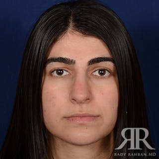 Female Rhinoplasty Before & After Gallery - Patient 301826 - Image 2