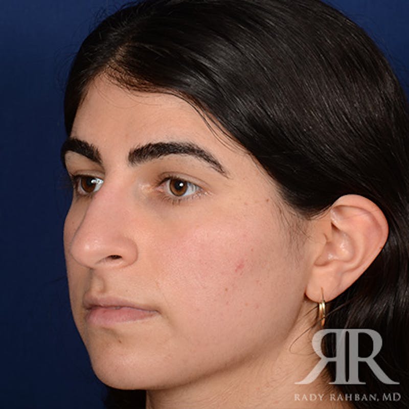 Female Rhinoplasty Before & After Gallery - Patient 301826 - Image 3