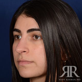 Female Rhinoplasty Before & After Gallery - Patient 301826 - Image 4
