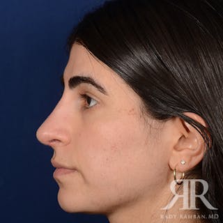 Female Rhinoplasty Before & After Gallery - Patient 301826 - Image 6