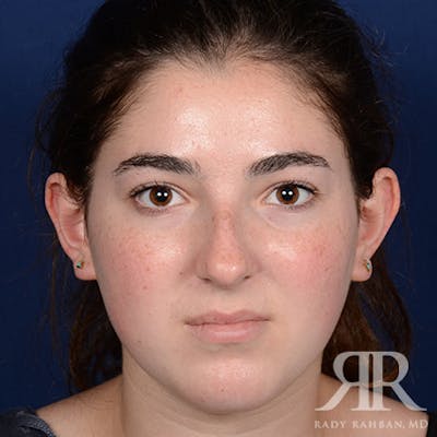 Female Rhinoplasty Before & After Gallery - Patient 173734 - Image 1
