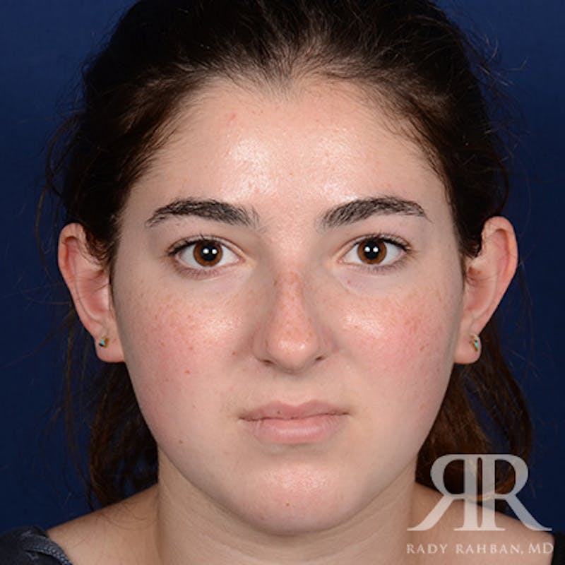 Female Rhinoplasty Before & After Gallery - Patient 173734 - Image 1