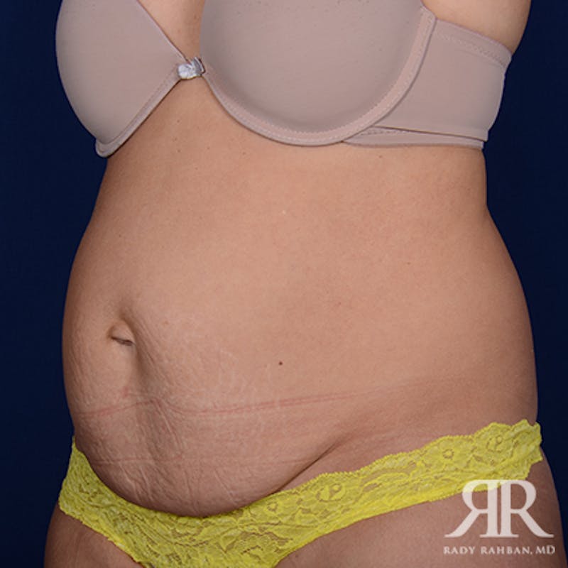 Tummy Tuck Before & After Gallery - Patient 650503 - Image 3