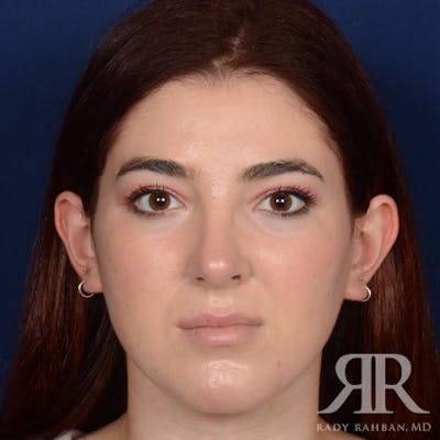 Female Rhinoplasty Before & After Gallery - Patient 173734 - Image 2