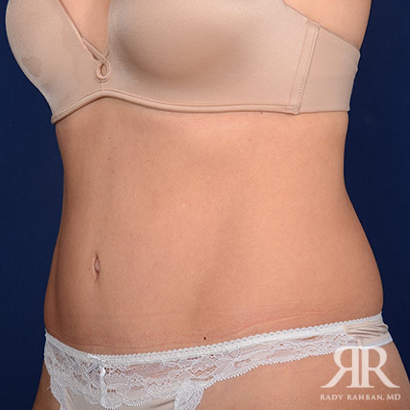 Tummy Tuck Before & After Gallery - Patient 650503 - Image 4
