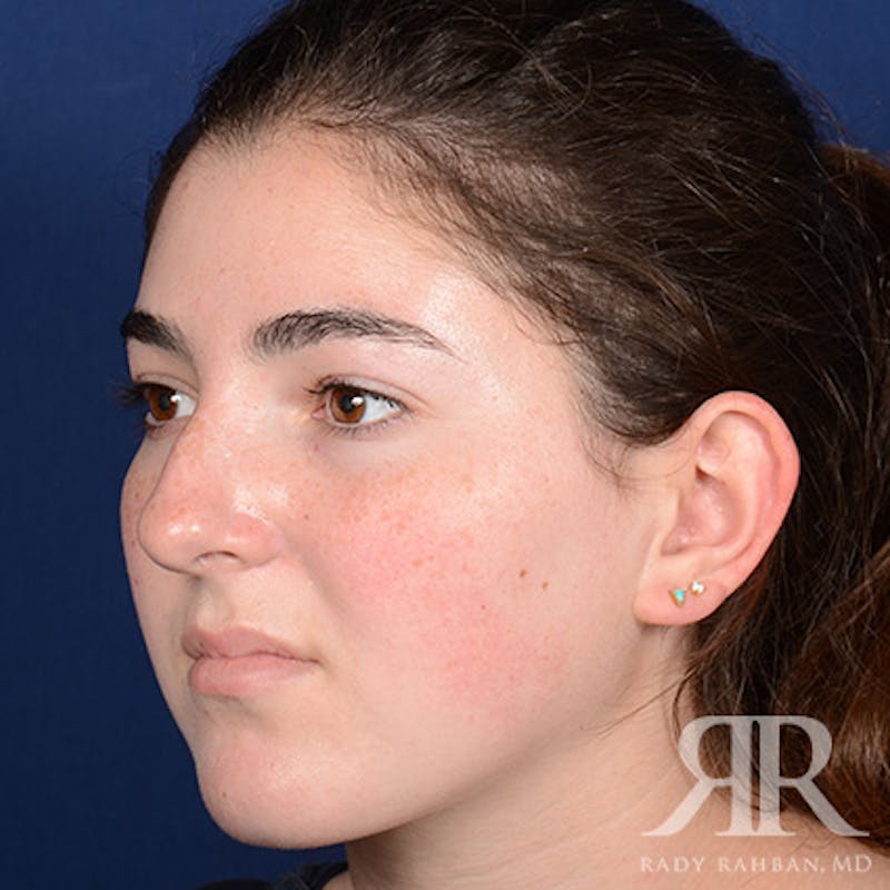 Female Rhinoplasty Before & After Gallery - Patient 173734 - Image 3