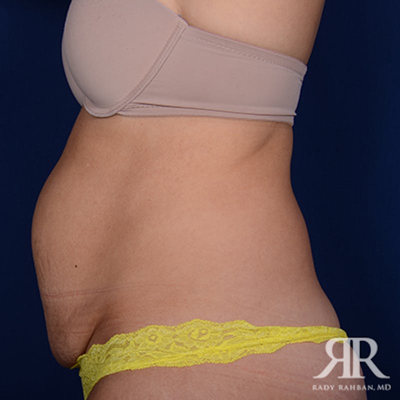 Tummy Tuck Before & After Gallery - Patient 650503 - Image 5