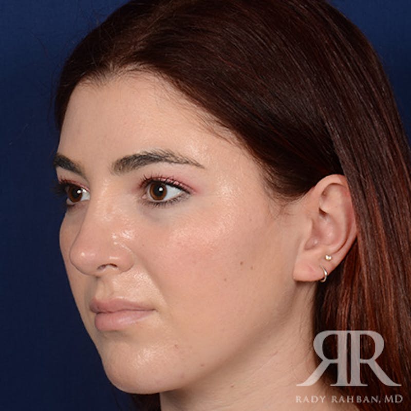 Female Rhinoplasty Before & After Gallery - Patient 173734 - Image 4