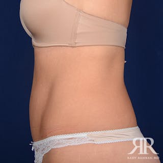 Tummy Tuck Before & After Gallery - Patient 650503 - Image 6