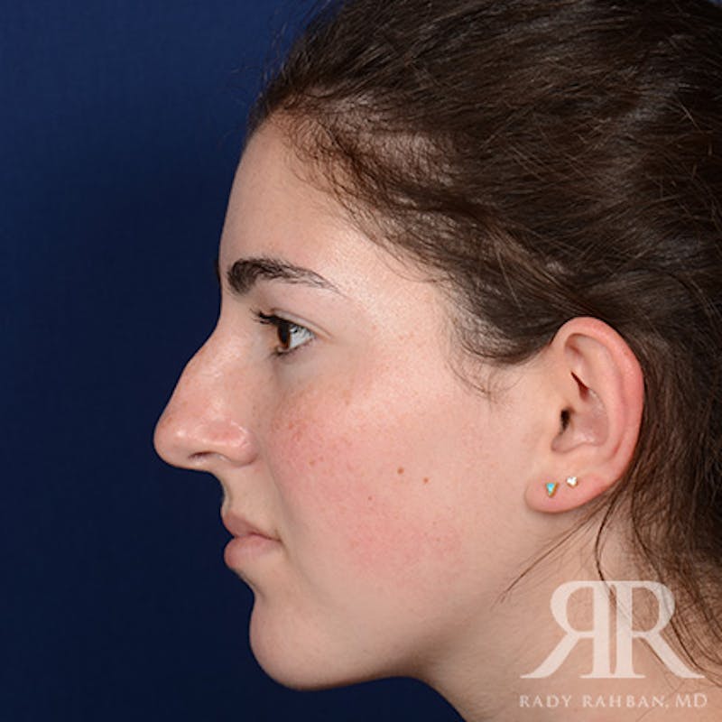 Female Rhinoplasty Before & After Gallery - Patient 173734 - Image 5