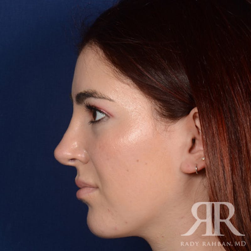 Female Rhinoplasty Before & After Gallery - Patient 173734 - Image 6