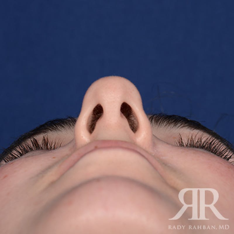 Female Rhinoplasty Before & After Gallery - Patient 173734 - Image 7