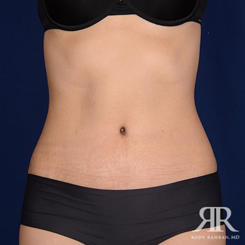 Tummy Tuck Before & After Gallery - Patient 334110 - Image 2