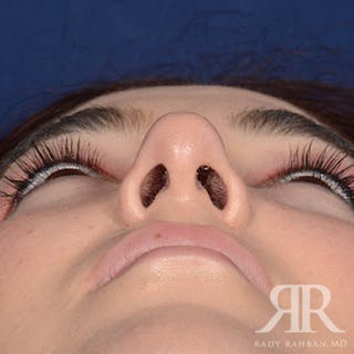 Female Rhinoplasty Before & After Gallery - Patient 173734 - Image 8