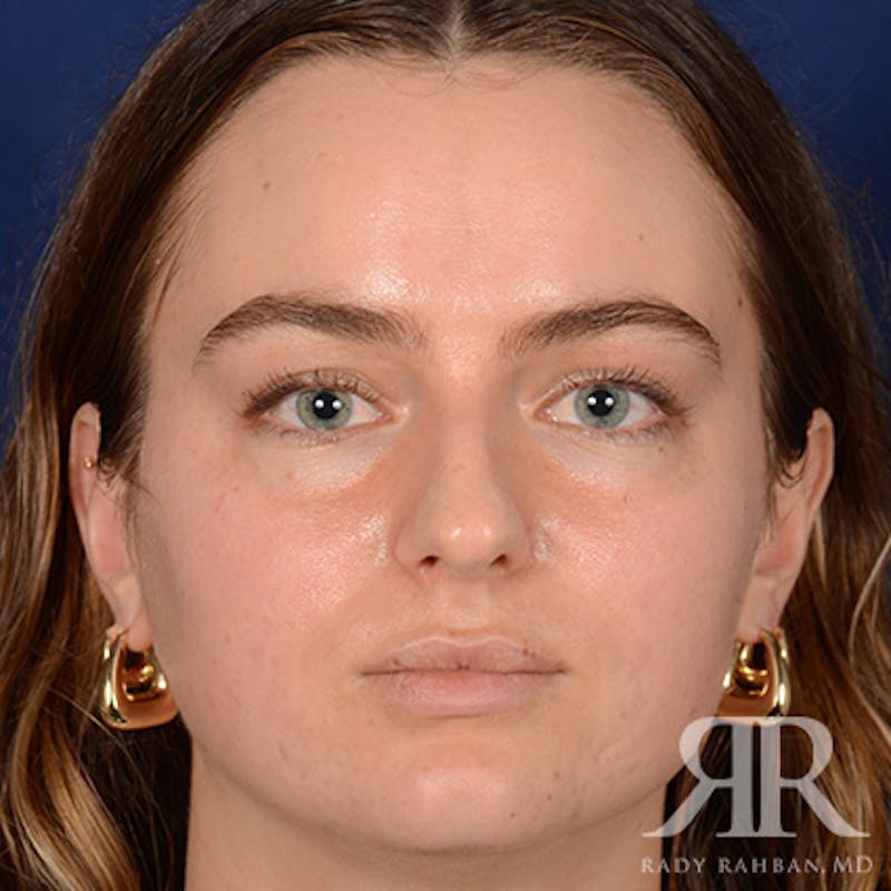 Female Rhinoplasty Before & After Gallery - Patient 274449 - Image 1