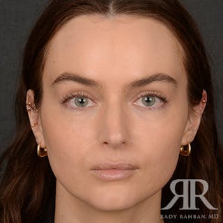 Female Rhinoplasty Before & After Gallery - Patient 274449 - Image 2