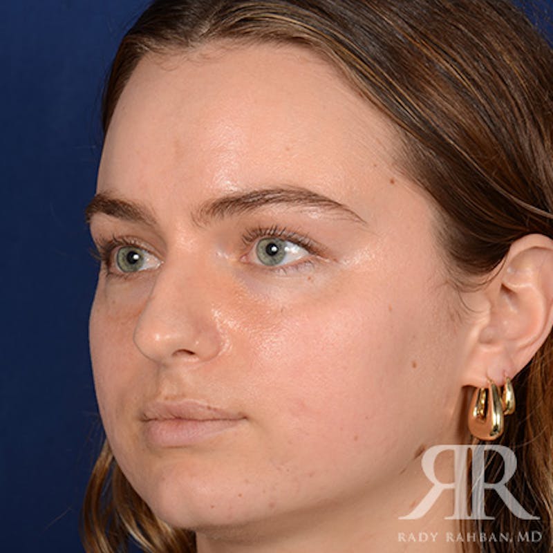 Female Rhinoplasty Before & After Gallery - Patient 274449 - Image 3