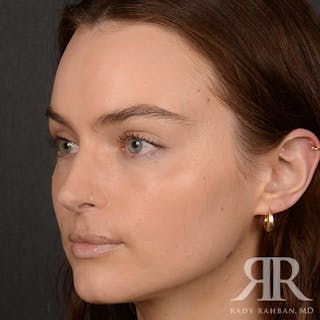 Female Rhinoplasty Before & After Gallery - Patient 274449 - Image 4