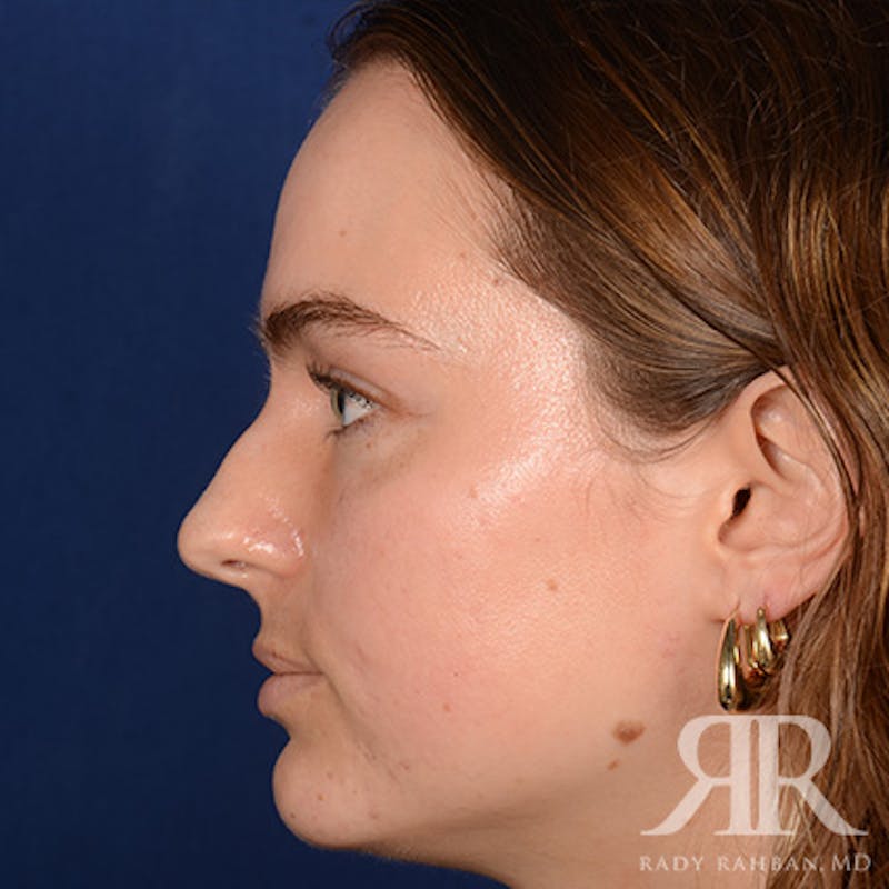 Female Rhinoplasty Before & After Gallery - Patient 274449 - Image 5