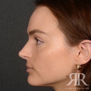 Female Rhinoplasty Before & After Gallery - Patient 274449 - Image 6