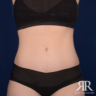 Tummy Tuck Before & After Gallery - Patient 346613 - Image 2