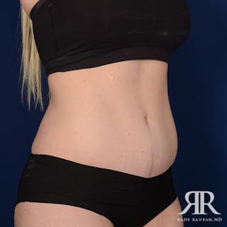Tummy Tuck Before & After Gallery - Patient 346613 - Image 4