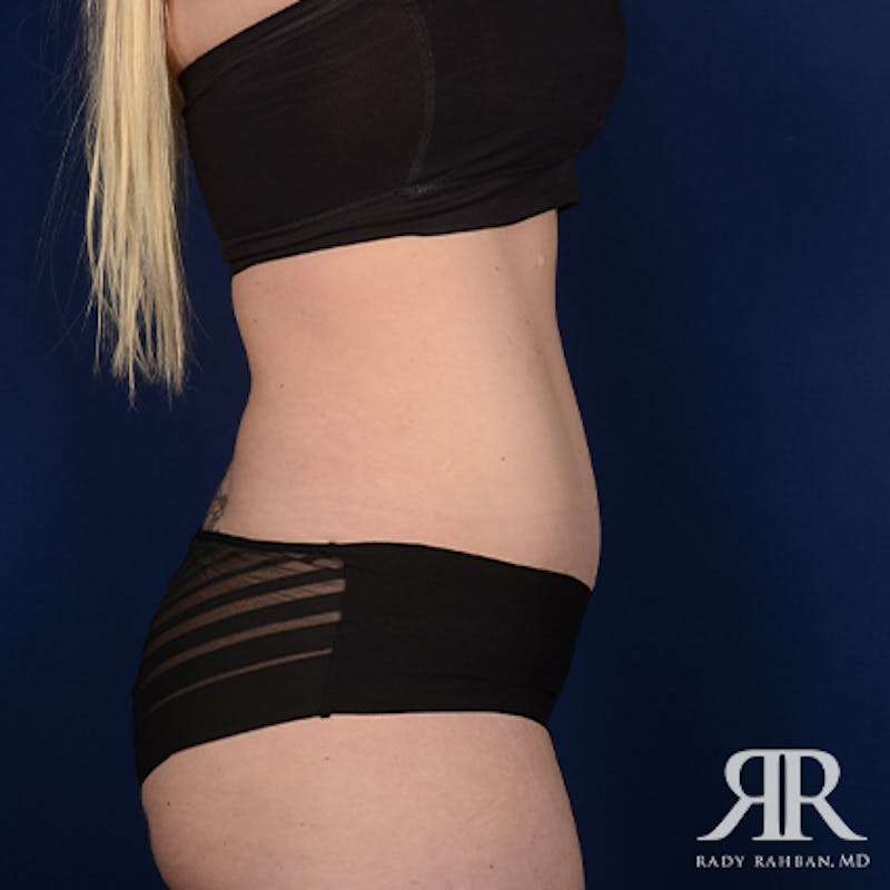 Tummy Tuck Before & After Gallery - Patient 346613 - Image 6