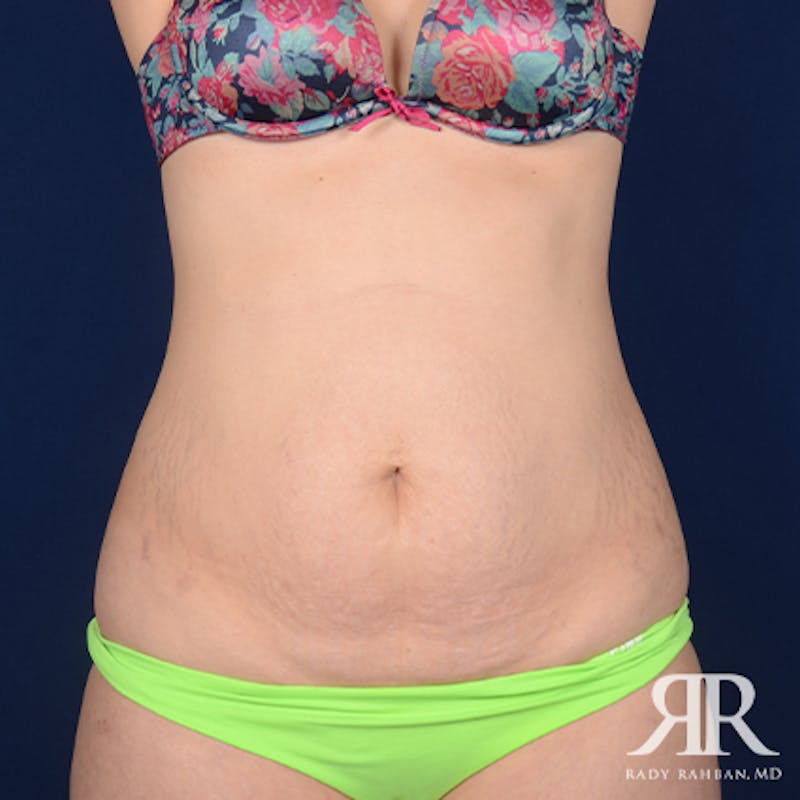 Tummy Tuck Before & After Gallery - Patient 264322 - Image 1