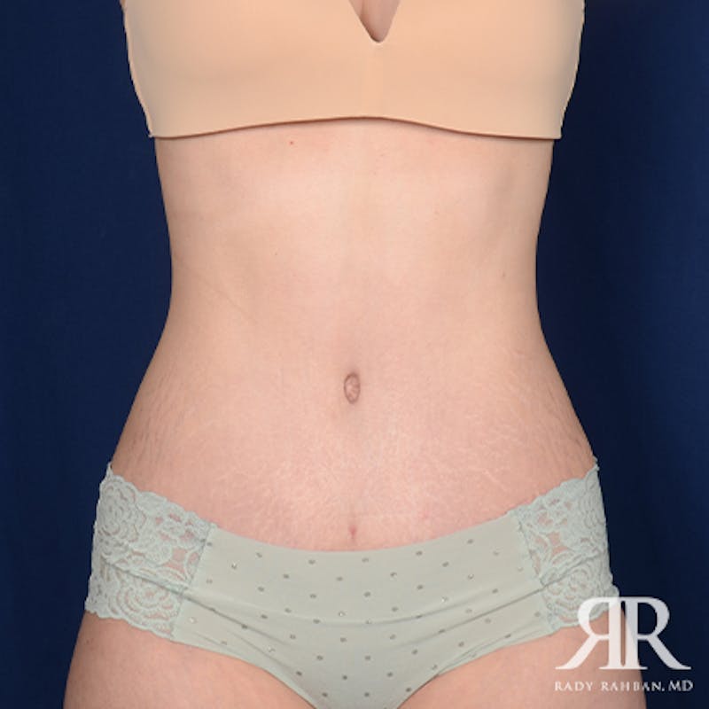 Tummy Tuck Before & After Gallery - Patient 264322 - Image 2