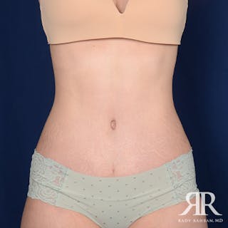 Tummy Tuck Before & After Gallery - Patient 264322 - Image 2